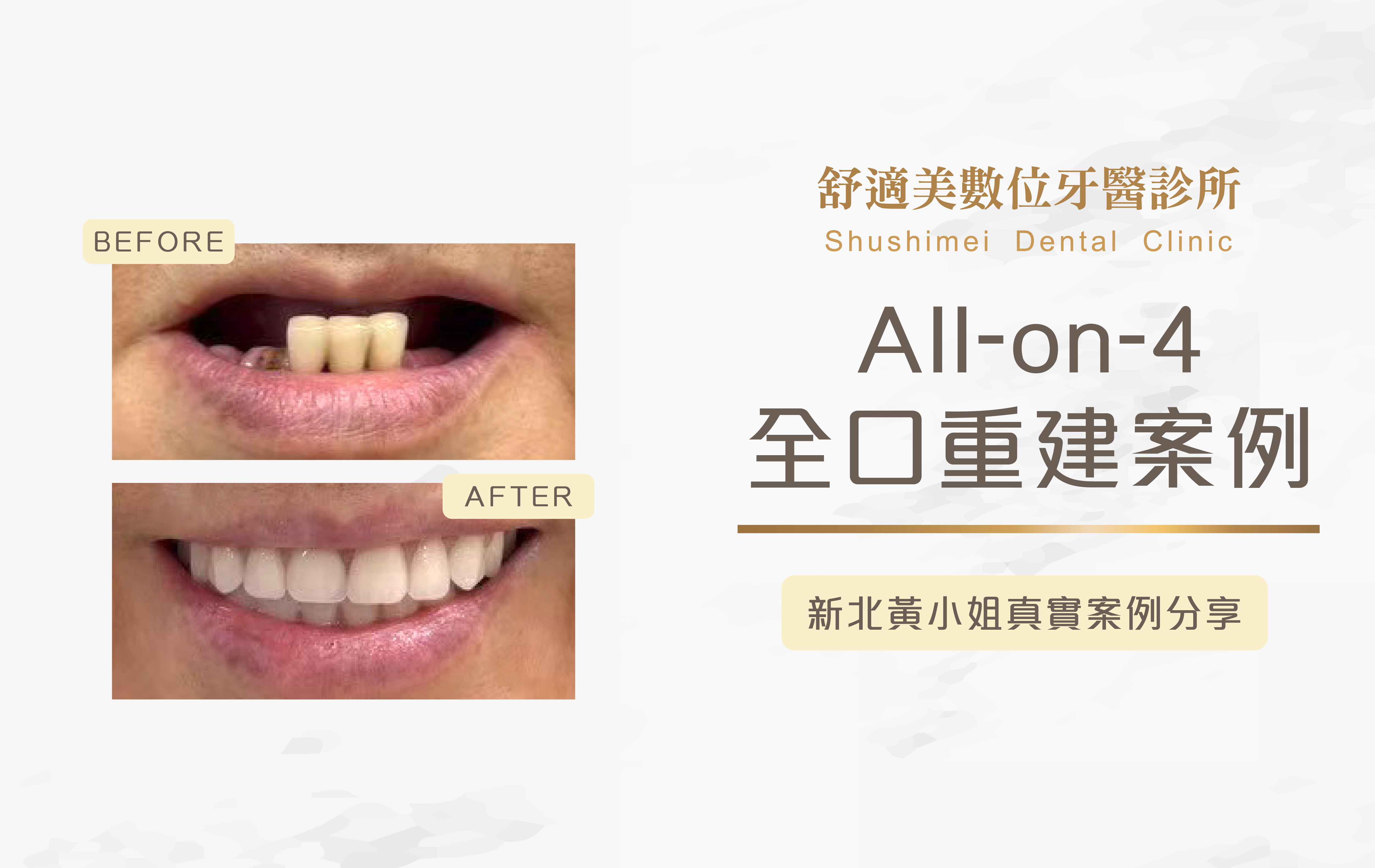 舒適美數位牙醫診所_黃女士使用活動假牙多年，終於靠All-on-4找回享樂人生!