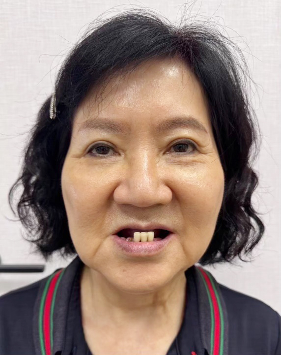 黃小姐術前照片