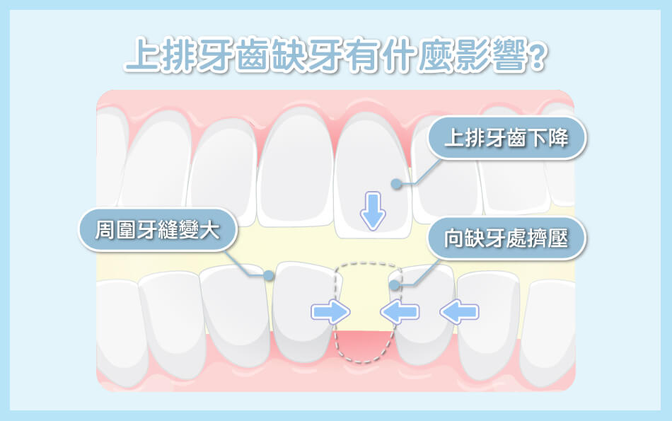 舒適美牙醫診所_「缺牙不重建」，可不是牙齦萎縮這麼簡單！