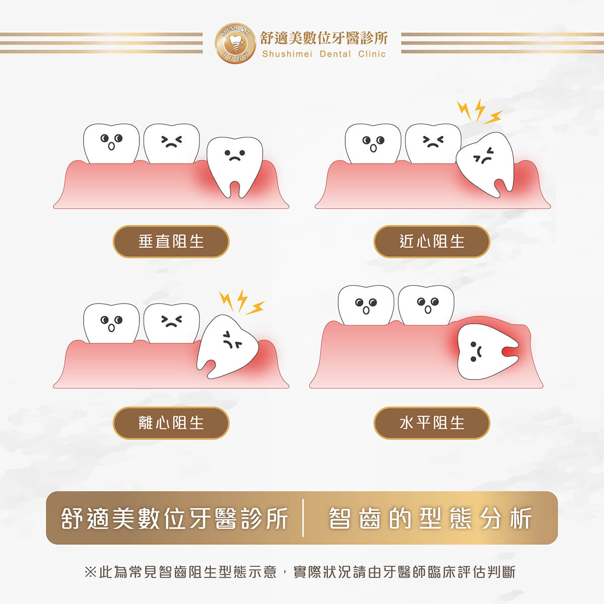 智齒的四種類型