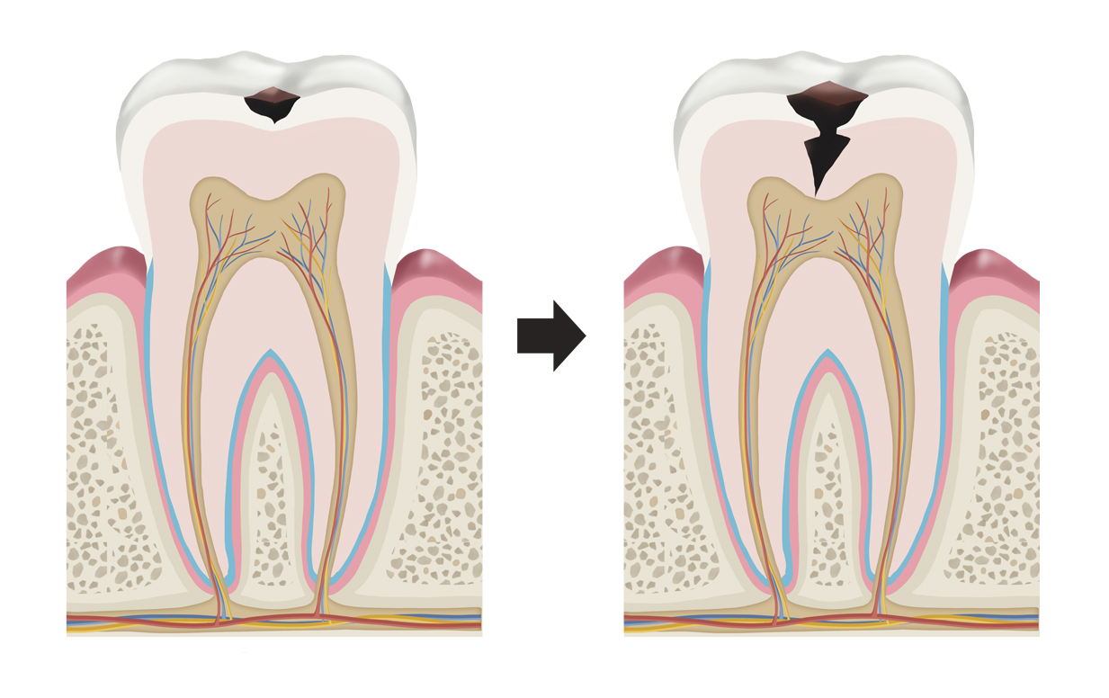 蛀牙示意圖，牙齒模型上有黑色蛀洞