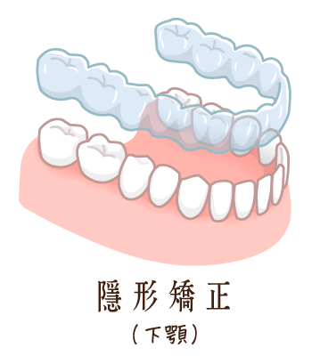 舒適美牙醫診所_隱形矯正下顎